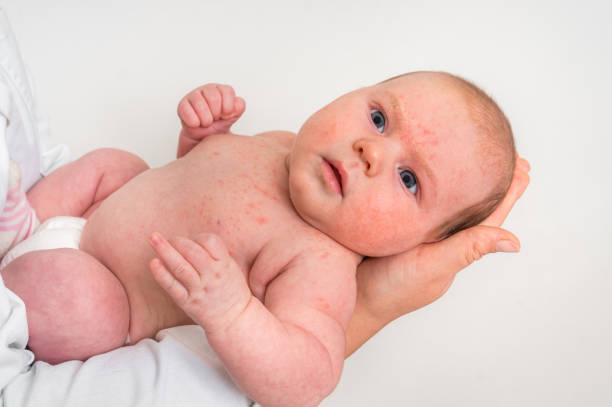 Newborn baby with skin rash. Allergic reaction after birth. stock photo