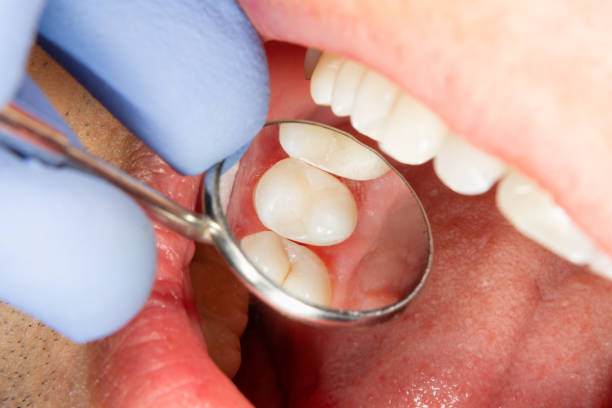 2 つの齲蝕の治療後上顎の側の歯を噛みます。充填材ラバーダムを用いたフォトポリマーにかみ砕く表面の復元 - child smiling human teeth dental hygiene ストックフォトと画像