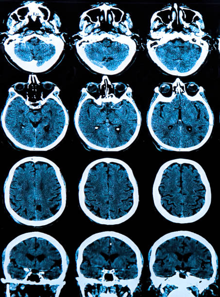 resonancia magnética del cerebro humano - phase image mri scan science nobody fotografías e imágenes de stock