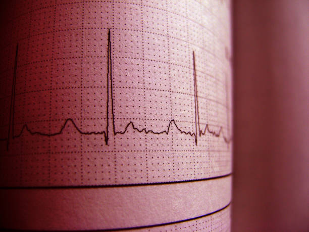 istock Sinus Heart Rhythm On Electrocardiogram Record Paper Showing Normal P Wave, PR and QT Interval and QRS Complex, EKG paper 1075539916