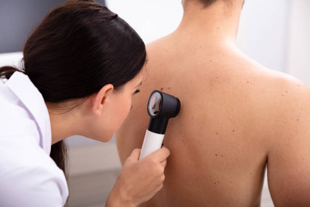 Doctor Examining Pigmented Skin On Man's Back Female Doctor Examining Pigmented Skin On Man's Back With Dermatoscope dermatology stock pictures, royalty-free photos & images