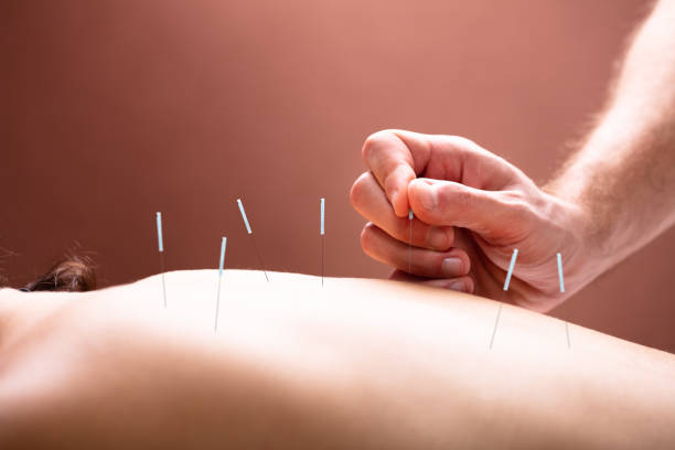 istock Therapist Performing Acupuncture Therapy On Woman's Back 1075627754