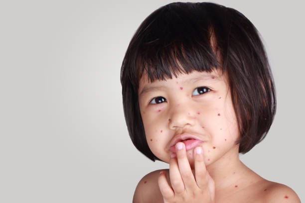 petite fille avec la variole - chickenpox skin condition baby illness photos et images de collection