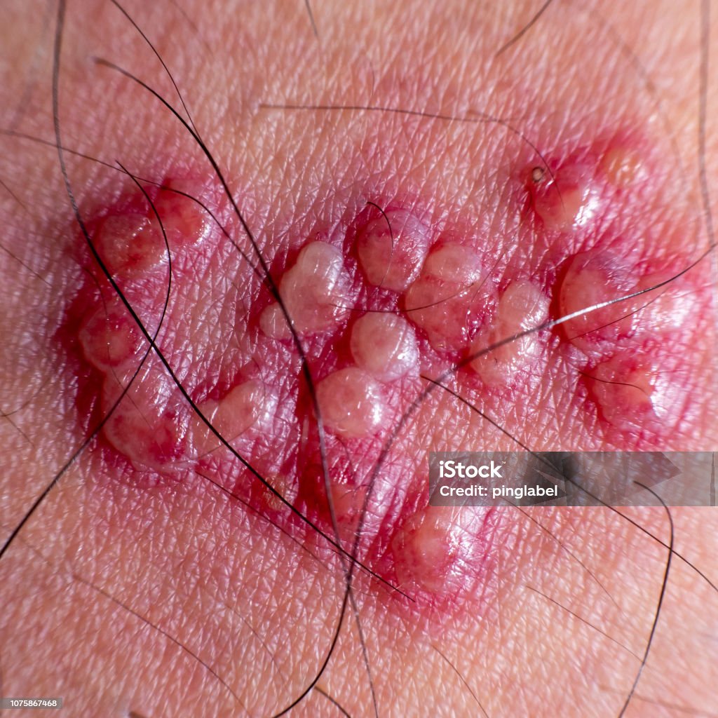colección Sudán María Erupciones En La Piel Y Ampollas En El Cuerpo Foto de stock y más banco de imágenes de Piel - Partes del cuerpo - iStock colección Sudán María Erupciones En La Piel Y Ampollas En El Cuerpo Foto de stock y más banco de imágenes de Piel - Partes del cuerpo - iStock
