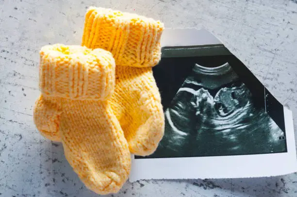 Photo of Knitted socks for the child, lying on the picture ultrasound. Waiting for the child, pregnancy. Selective focus.