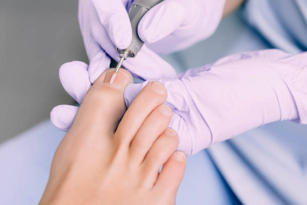 podologue ou un traitement pied du patient, traitement de pédicure - podiatrist podiatry pedicure chiropodist photos et images de collection