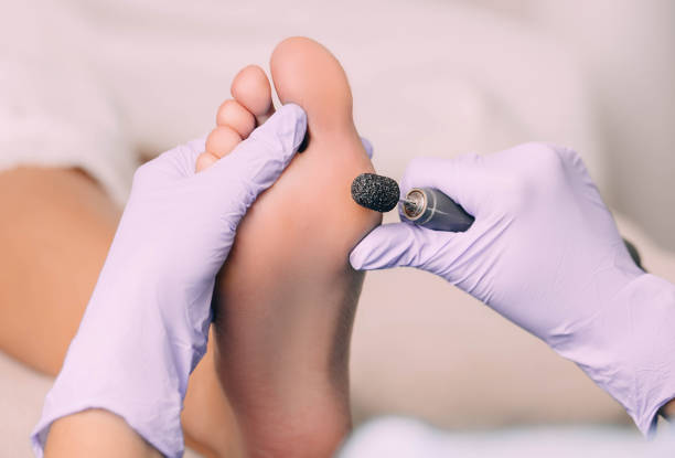 chiropodista che cura il piede di un paziente, trattamento pedicure - podiatrist foto e immagini stock