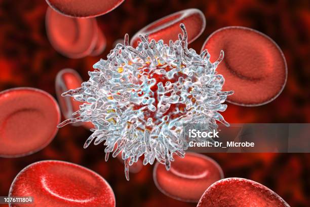 Hairy Cell Leukemia Stock Photo - Download Image Now - Leukemia, Biological Cell, Lymphocyte