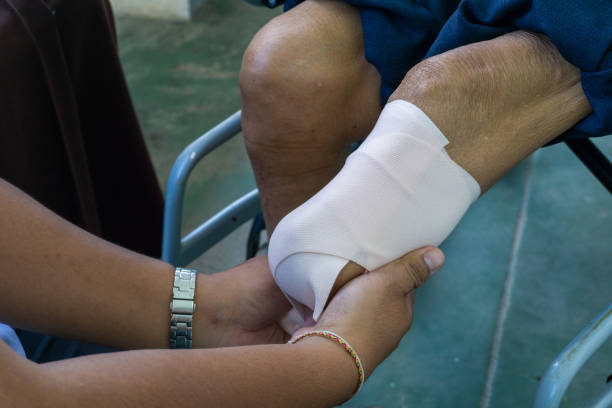 bandage élastique d’amputation du genou au-dessous - manchot photos et images de collection
