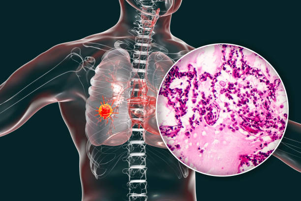 câncer de pulmão, ilustração e fotografia sob microscópio - adenocarcinoma - fotografias e filmes do acervo