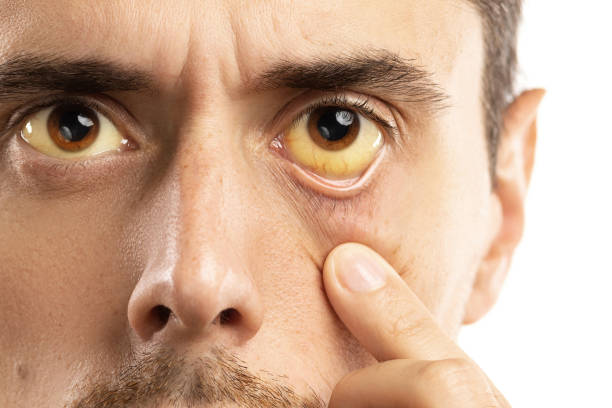 Yellowish eyes is sign of problems with liver, viral infection or other disease Man checking his health condition. Yellowish eyes is sign of problems with liver, viral infection or other disease. hepatitis photos stock pictures, royalty-free photos & images