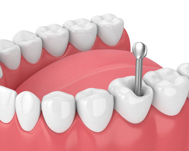 istock 3d render of jaw with teeth and dental metal post 1076420712