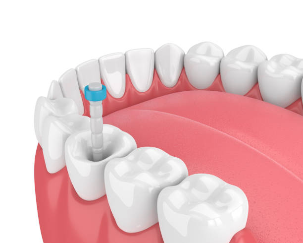 istock 3d render of jaw with teeth and fiber post 1076422446