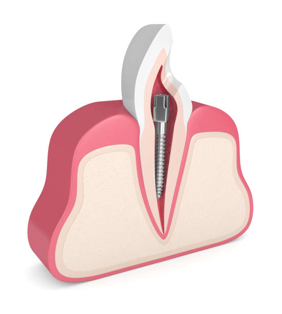 istock 3d render of tooth with dental metal post 1076425498