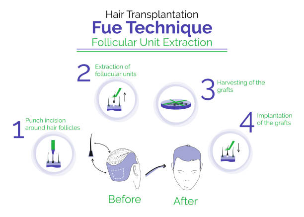 ilustrações de stock, clip art, desenhos animados e ícones de hair transplantation fue technic. procedure - hair net