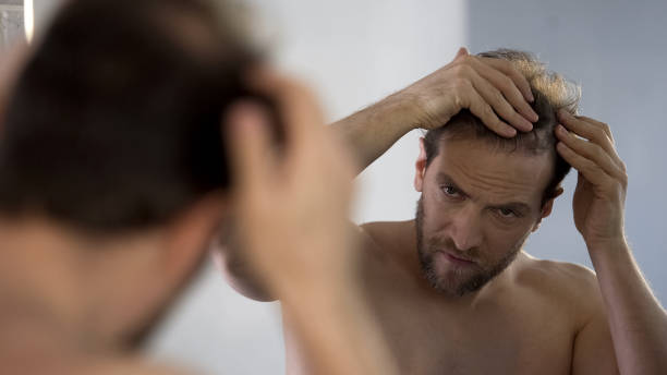 istock Middle-aged man looking in mirror at his bald patches, hair loss problem 1076947012