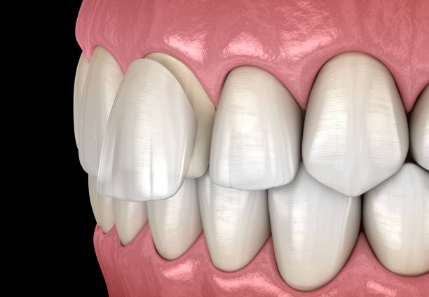 Dental Veneer: Central incisor Veneer installation Procedure. Medically accurate tooth 3D illustration Dental Veneer: Central incisor Veneer installation Procedure. Medically accurate tooth 3D illustration teeth bonding stock pictures, royalty-free photos & images