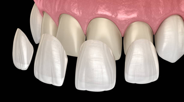istock Veneer installation procedure over central incisor and lateral incisor. Medically accurate tooth 3D illustration 1077065676