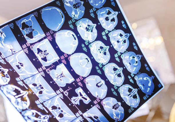 istock x-ray film of the head computed tomography 1077160364