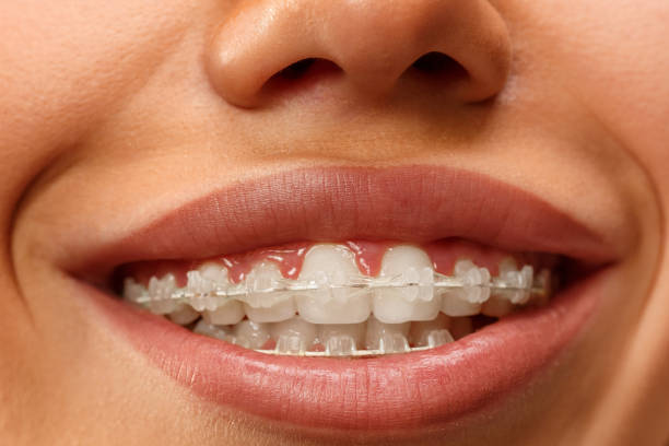 istock Beautiful young woman with teeth braces 1077188990