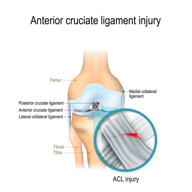 ilustraciones, imágenes clip art, dibujos animados e iconos de stock de lesión del ligamento cruzado anterior - cruciate ligament