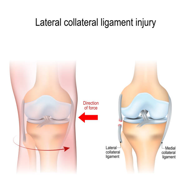 Fibular collateral ligament injury. Fibular collateral ligament injury. joint anatomy. Vector illustration for biological, medical, science and educational use posterior cruciate ligament stock illustrations