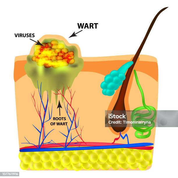 The Structure Of The Wart The Structure Of The Skin Infographics Vector ...