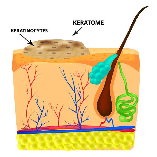 Vector illustration of The structure of keratoma. Keratosis. The structure of moles on the skin. Infographics. Vector illustration on isolated background.
