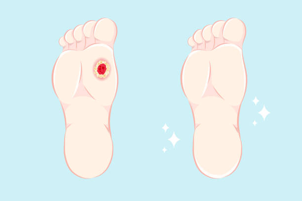 stockillustraties, clipart, cartoons en iconen met zweren op de voet - pedicure