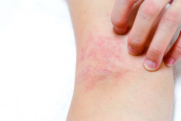 istock Women's hands are scratching allergy to red rash on white background 1077947874