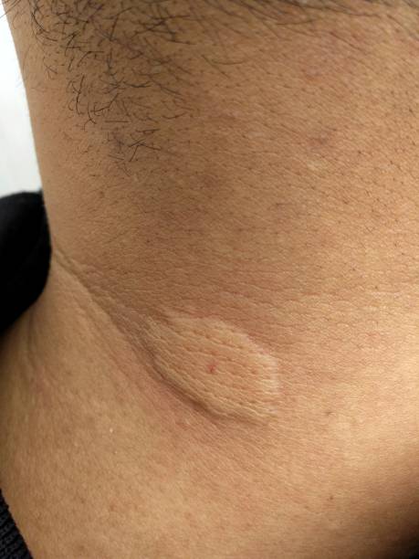 istock man neck after bee stings 1078073850