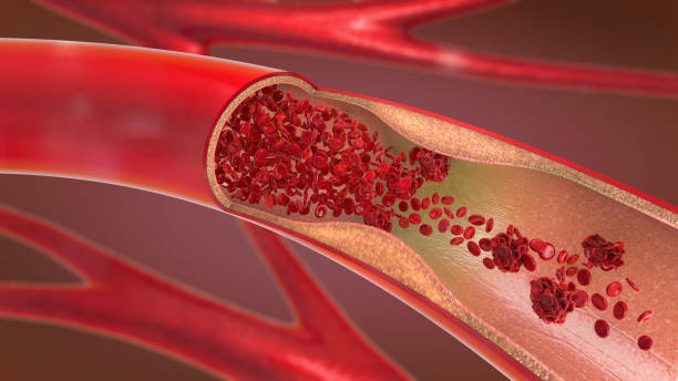 ilustración 3d de una estrechamiento y constricción de la arteria y la sangre no puede fluir correctamente llamado arteriosclerosis - coágulo de sangre fotografías e imágenes de stock