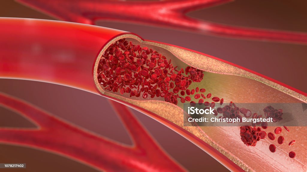 3d illustration of a constricted and narrowed artery and the blood cannot flow properly called arteriosclerosis Blood Vessel Stock Photo