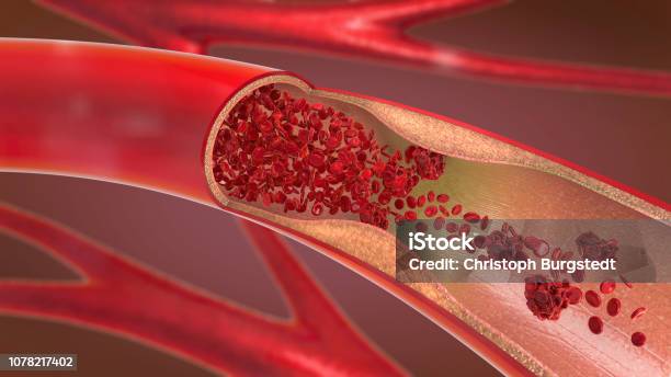 3d Illustration Of A Constricted And Narrowed Artery And The Blood Cannot Flow Properly Called Arteriosclerosis Stock Photo - Download Image Now