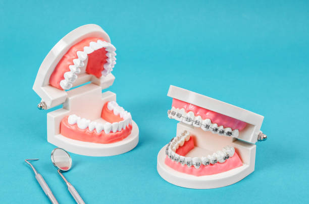 istock Tooth model with metal wire dental braces 1078478706