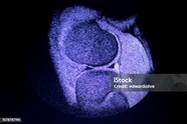 Magnetic Resonance Imaging Mri Knee Posterior Horn Medial Meniscus Tear Scantest Results Stock Photo - Download Image Now