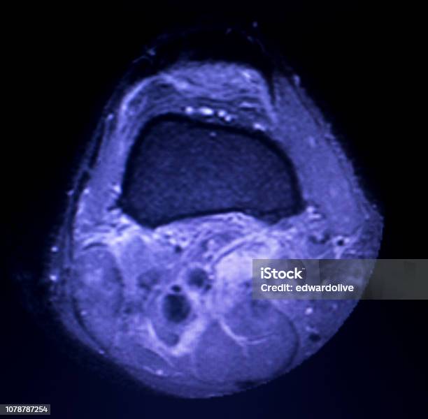 Magnetic Resonance Imaging Mri Knee Posterior Horn Medial Meniscus Tear Scantest Results Stock Photo - Download Image Now