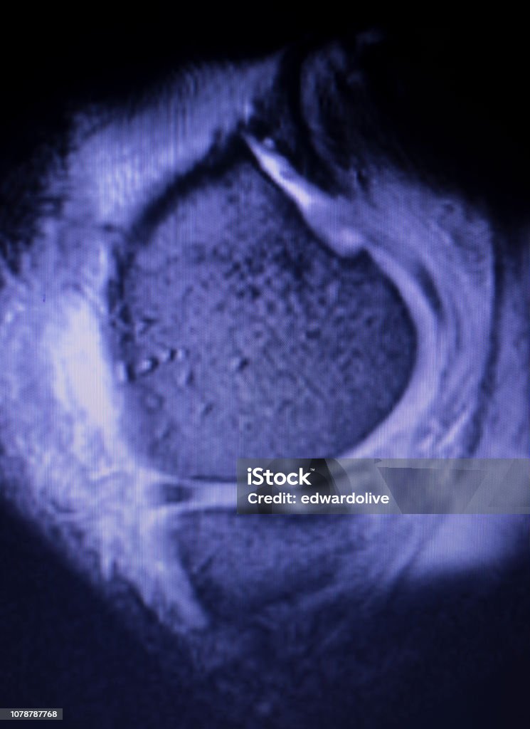 Magnetic resonance imaging MRI knee posterior horn medial meniscus tear scantest results. Anatomy Stock Photo
