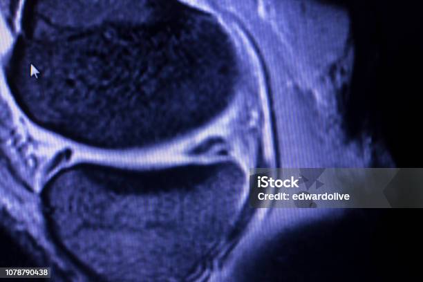 Magnetic Resonance Imaging Mri Knee Posterior Horn Medial Meniscus Tear Scantest Results Stock Photo - Download Image Now