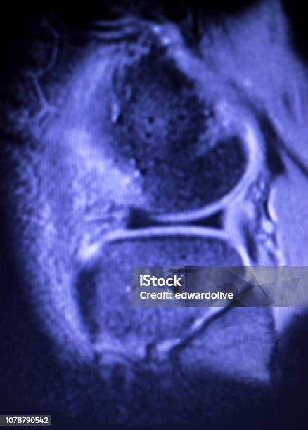 Magnetic Resonance Imaging Mri Knee Posterior Horn Medial Meniscus Tear Scantest Results Stock Photo - Download Image Now