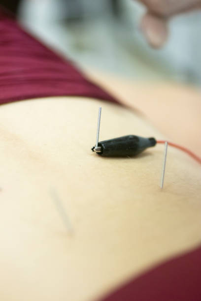 istock Physiotherapy clinic Intratissue Percutaneous Electrolysis EPI dry needling physiotherapist patient injury. 1079189618
