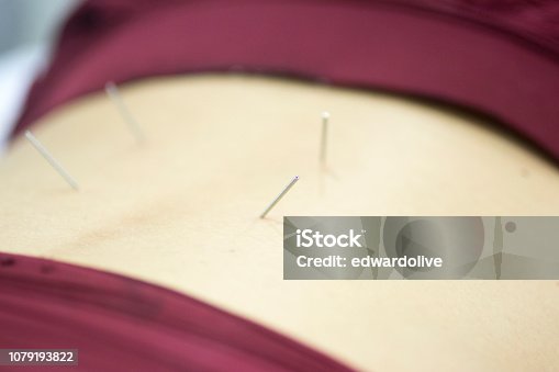 istock Physiotherapy clinic Intratissue Percutaneous Electrolysis EPI dry needling physiotherapist patient injury. 1079193822