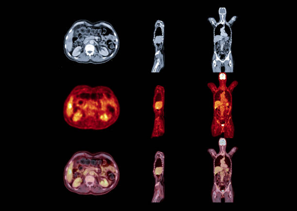 immagine pet scan di tutto il corpo confronto assiale, coronale e piano sagittale. concetto di tecnologia medica. - pet foto e immagini stock