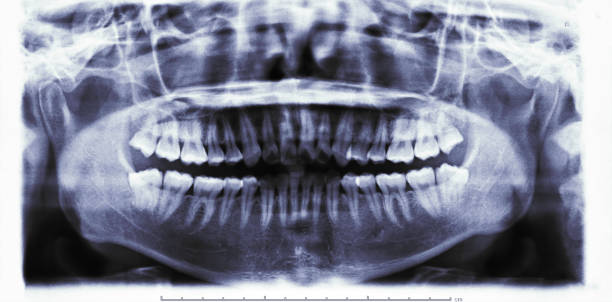 istock Panoramic dental x-ray image or orthopantomogram of jaw with all teeth 1079302406