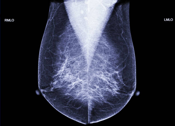 istock X-ray Digital Mammogram both side, mammography breast scan name is MLO view. 1079302460