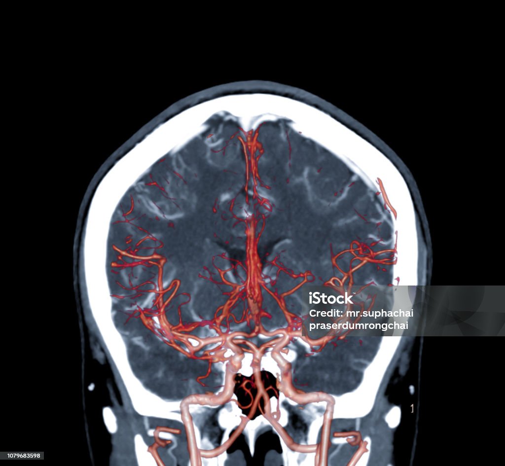 Chụp Ct Mạch Máu Não Coronal View 3d Hình Ảnh Kết Xuất Cho Thấy ... Image hình ảnh con người hình ảnh con người hình ảnh con người hình ảnh con người Dương Quang - Chụp Ct Mạch Máu Não Coronal View 3d Hình Ảnh Kết Xuất Cho Thấy ...