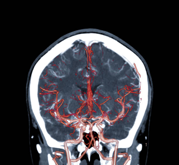 Chụp Ct Mạch Máu Não Coronal View 3d Hình Ảnh Kết Xuất Cho Thấy ... Image hình ảnh con người hình ảnh con người hình ảnh con người hình ảnh con người Dương Quang - Chụp Ct Mạch Máu Não Coronal View 3d Hình Ảnh Kết Xuất Cho Thấy ...