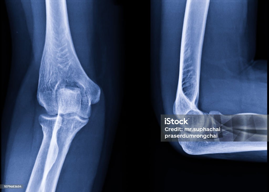 Radiography of Right elbow AP and Lateral position. Medical concept. Elbow Stock Photo