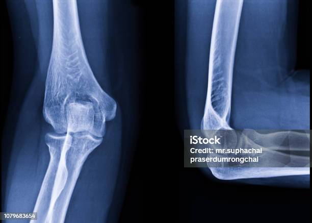 Radiography Of Right Elbow Ap And Lateral Position Medical Concept Stock Photo - Download Image Now