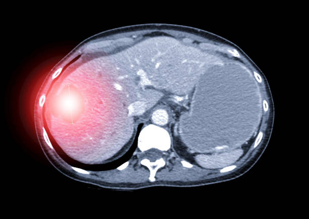 computer tomography, ct scan of upper abdomen  showing large liver mass or hepatic cyst. - human upper body xray imagens e fotografias de stock